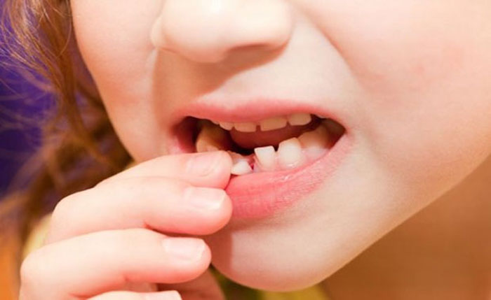 Thời gian nhổ răng sữa còn tùy thuộc từng tình trạng răng cụ thể
