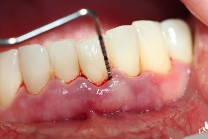 Viêm quanh cuống răng là bệnh lý khá phổ biến