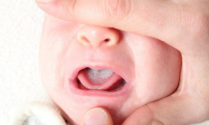 Bệnh tưa lưỡi gây ra mảng trắng sữa hoặc vàng trên bề mặt lưỡi và má trong