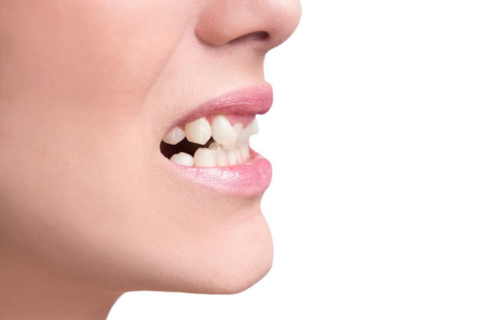 Bọc răng sứ chỉ có thể áp dụng cho trường hợp răng khểnh chìa ra ngoài nhẹ