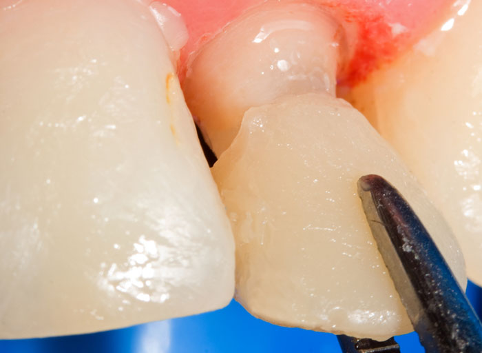 Bọc răng sứ giúp cải thiện tình trạng chiếc răng nanh mọc lệch