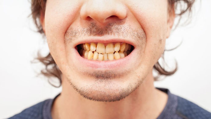 Bút tẩy trắng không mang lại kết quả với trường hợp răng ố vàng nặng
