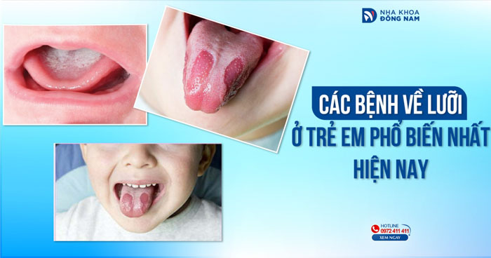 Các bệnh về lưỡi ở trẻ em phổ biến nhất hiện nay