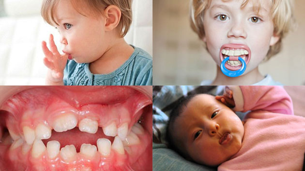 Các thói quen lúc nhỏ rất dễ làm cho hàm răng mọc lệch lạc