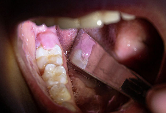 Cắt lợi trùm răng khôn trong trường hợp răng mọc thẳng, không có bệnh lý