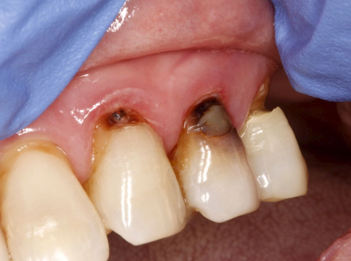 Chân răng bị mục khiến cấu trúc răng hư hỏng nặng dần theo thời gian