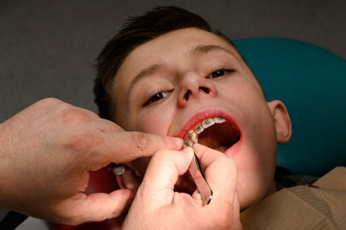 Đau khi niềng răng là triệu chứng bình thường
