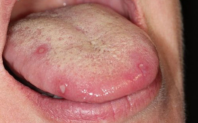 Loét lưỡi Apthae thường gây cảm giác đau rát vô cùng khó chịu