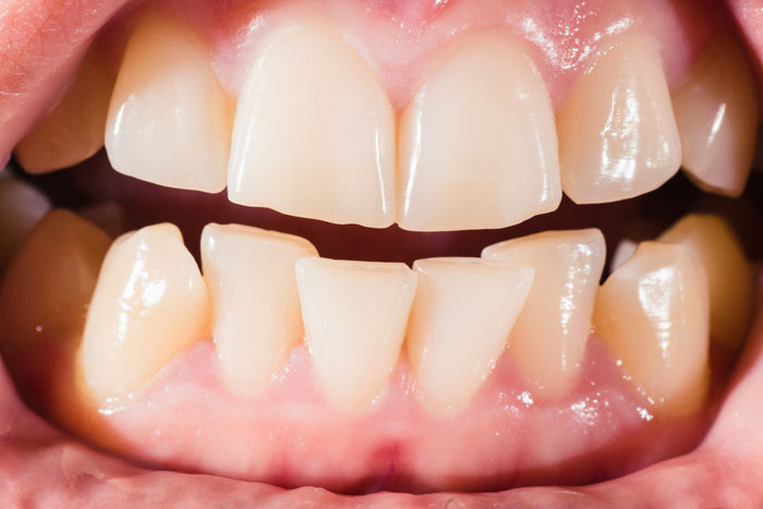 Mất răng sữa sớm làm tăng nguy cơ răng vĩnh viễn mọc lệch, khấp khểnh