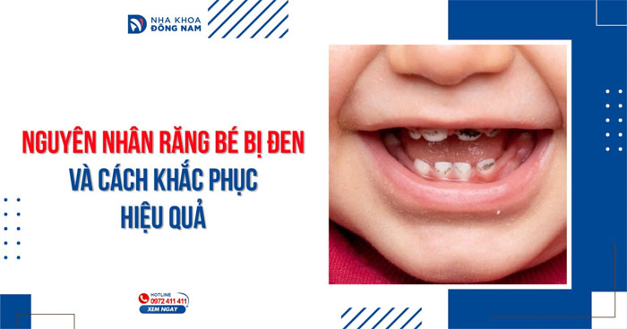 Nguyên nhân răng bé bị đen và cách khắc phục hiệu quả