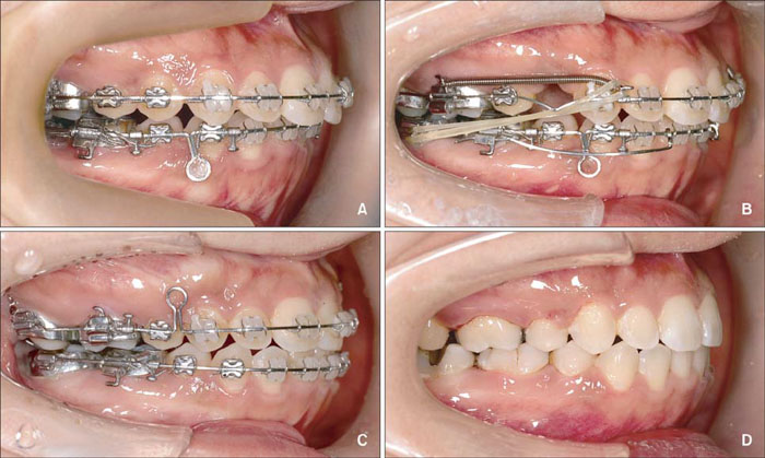 Nhổ răng để niềng nhằm tạo khoảng trống giúp răng dịch chuyển thuận lợi