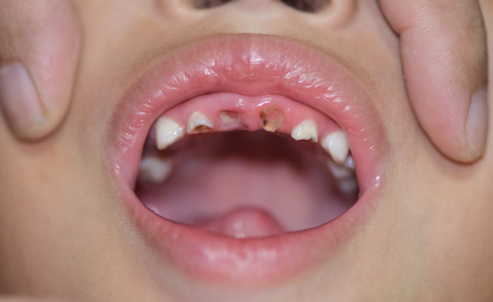 Nhổ răng sữa sớm trong trường hợp răng sâu nghiêm trọng