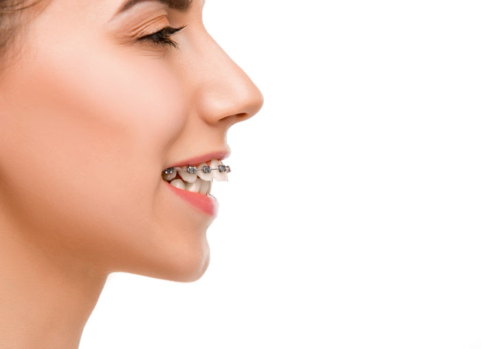 Niềng răng giúp bảo tồn cấu trúc răng thật