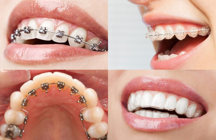 Niềng răng phù hợp cho mọi tình trạng răng mọc không đều