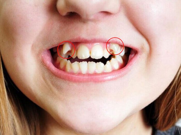 Răng khểnh là chiếc răng nanh hàm trên mọc lệch