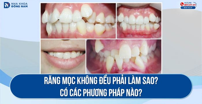Răng mọc không đều phải làm sao? Có các phương pháp nào?
