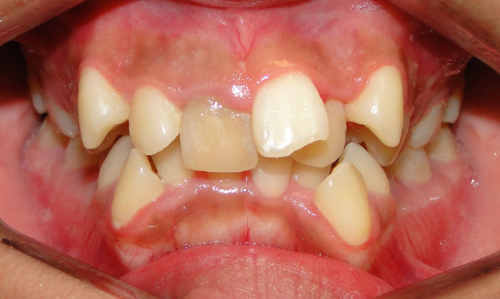 Răng mọc sai lệch quá nặng cần phải nhổ răng để tạo khoảng trống