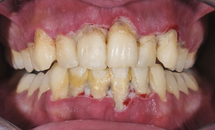 Răng viêm nhiễm nặng nề do mảng bám cao răng tích tụ lâu ngày