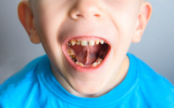 Sâu răng là nguyên nhân khiến trẻ thay răng sớm