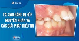 Tại sao răng bị hô? Nguyên nhân và các giải pháp điều trị