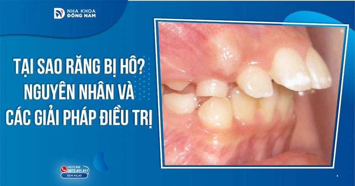 Tại sao răng bị hô? Nguyên nhân và các giải pháp điều trị