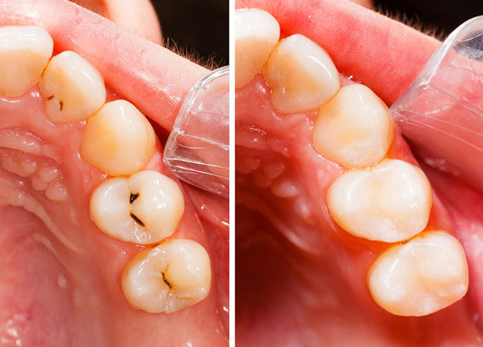 Trám răng giúp khắc phục tình trạng sâu răng
