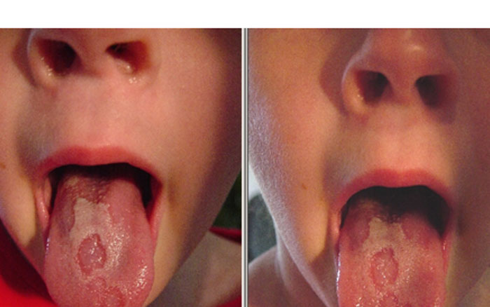 Viêm lưỡi bản đồ ở trẻ em là bệnh lý khá phổ biến