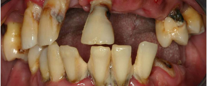 Viêm nha chu nghiêm trọng nguy cơ cao gây mất răng vĩnh viễn