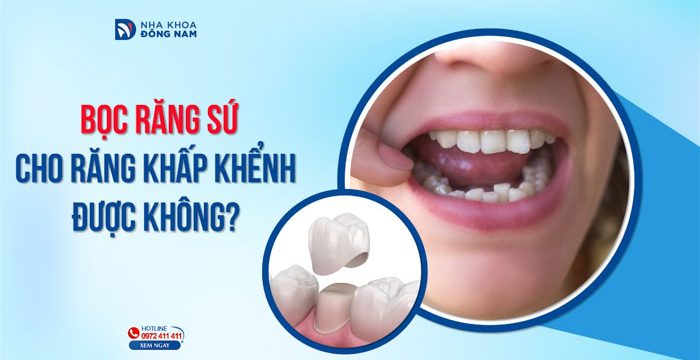 Bọc sứ cho răng khấp khểnh được không?