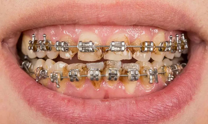 Cao răng là nguyên nhân gây tụt lợi khi niềng răng