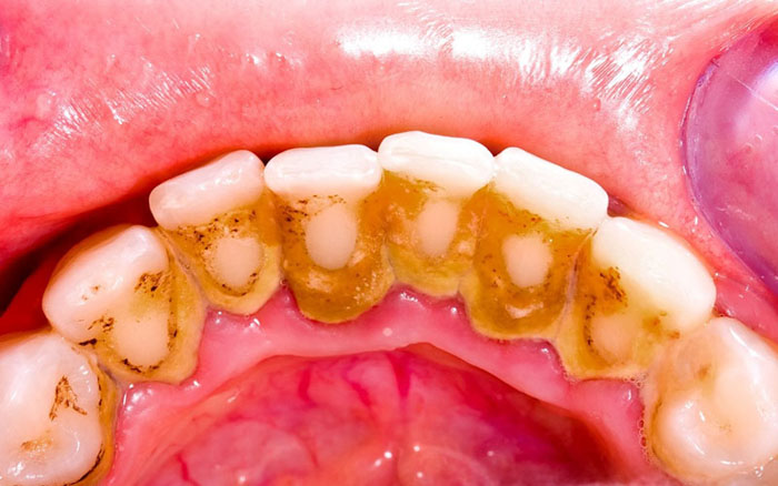 Cao răng tích tụ dày đặc khó tránh khỏi tình trạng chảy máu khi lấy cao răng