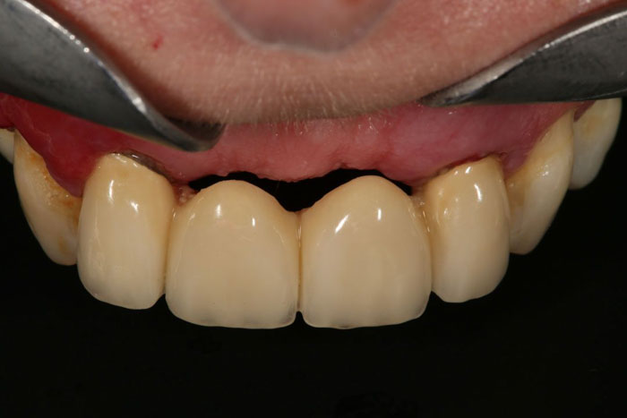 Cầu răng sứ không thể khắc phục tiêu xương hàm do mất răng