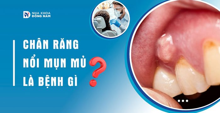 Chân răng nổi mụn mủ là bệnh gì?