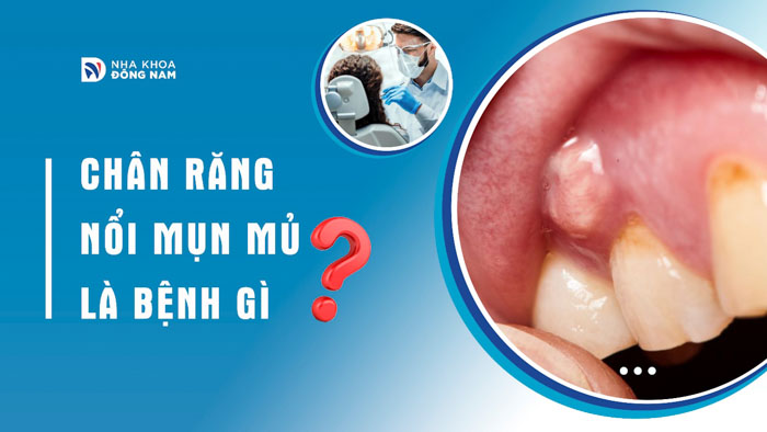 Chân răng nổi mụn mủ là bệnh gì?
