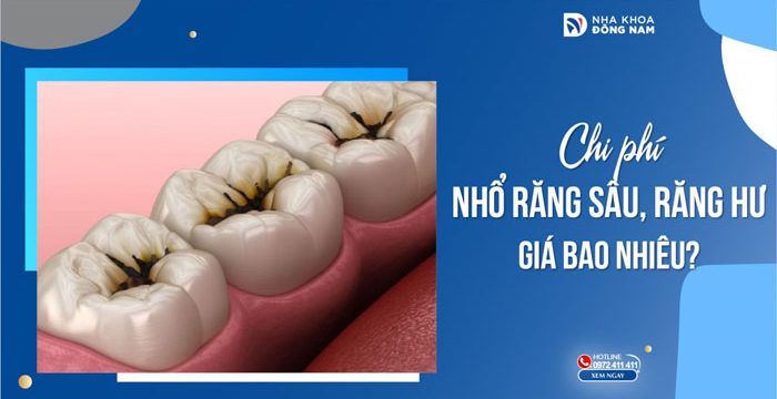 Chi phí Nhổ Răng Sâu, Răng Hư giá bao nhiêu?