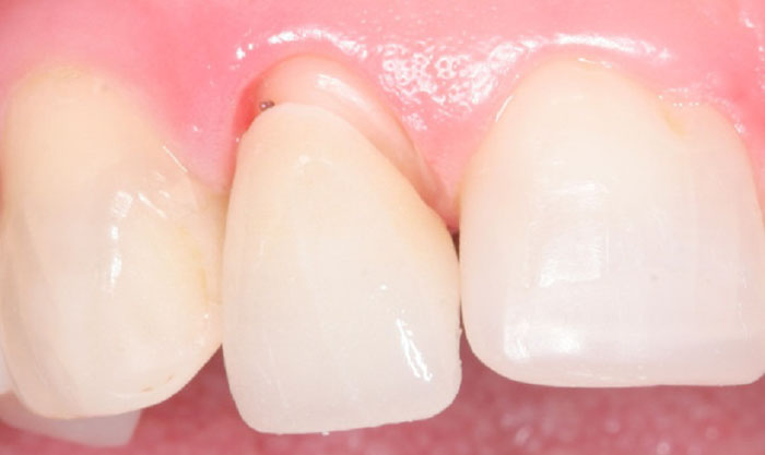 Ê buốt, đau răng khi nhai có thể là do bọc răng sứ bị hở