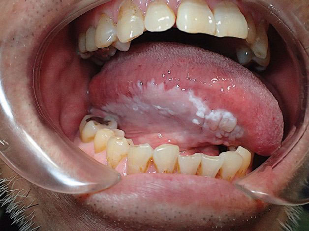 Hình ảnh bệnh bạch sản ở lưỡi