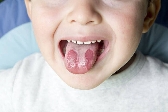 Hình ảnh bệnh viêm lưỡi bản đồ ở trẻ em
