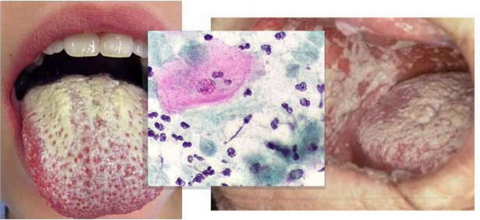 Hình ảnh của bệnh nấm lưỡi