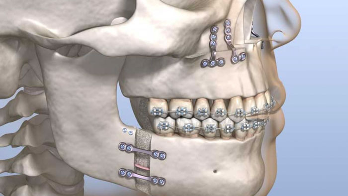 Kết hợp niềng răng với phẫu thuật hàm