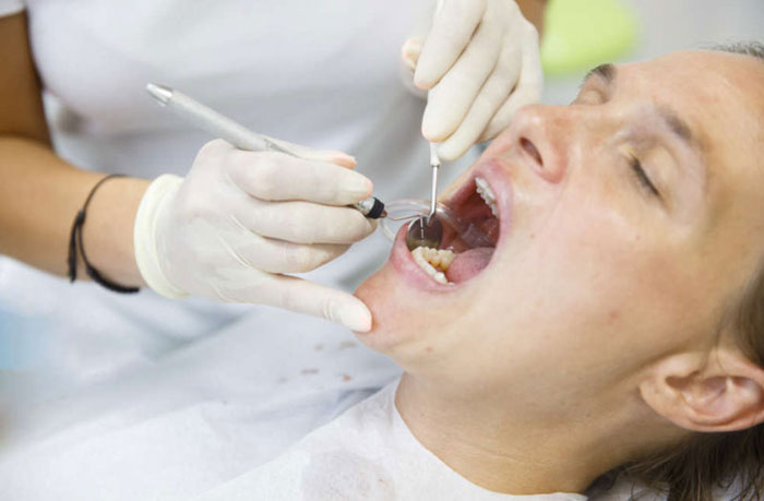 Kỹ thuật cao vôi không chuẩn xác dễ gây chảy máu nướu răng