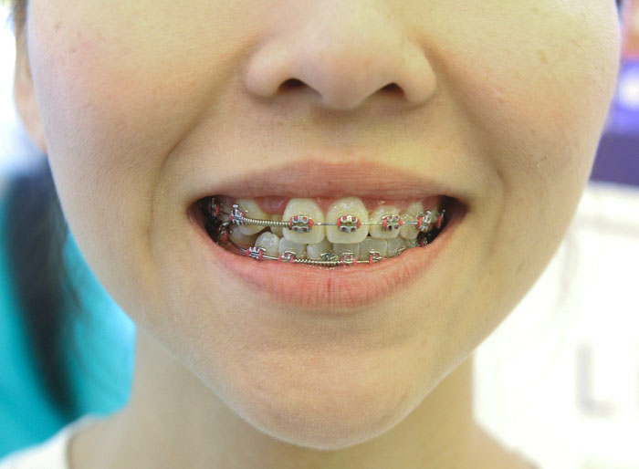 Kỹ thuật niềng răng giúp sắp xếp các răng về vị trí mong muốn