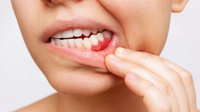 Lạm dụng miếng dán tẩy trắng răng gây viêm nướu