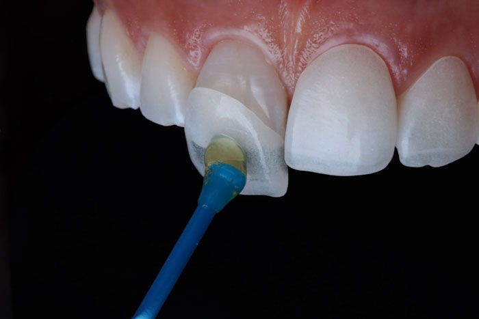 Mặt dán sứ giúp hạn chế tỷ lệ mài răng nhưng điều kiện là các răng phải đều đặn
