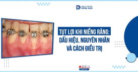 Nguyên nhân, dấu hiệu và cách điều trị tụt lợi khi niềng răng