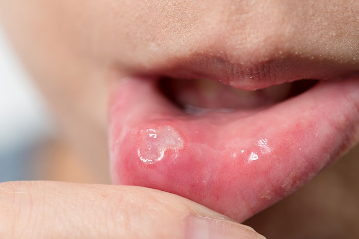 Nhiệt miệng có thể xuất phát từ thói quen ăn uống vệ sinh răng miệng