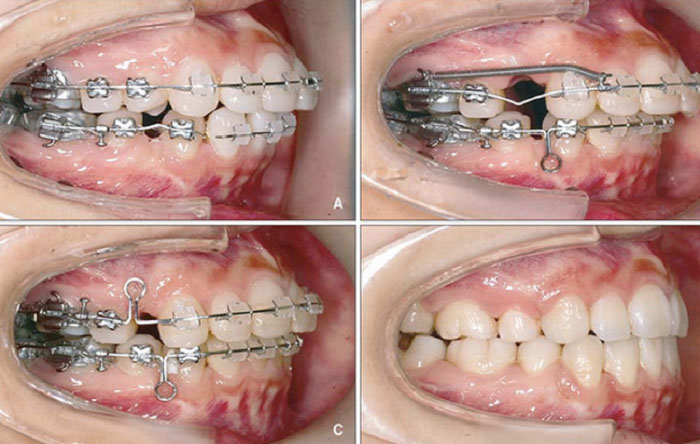 Nhổ răng khi niềng để tạo chỗ trống giúp răng dịch chuyển hiệu quả