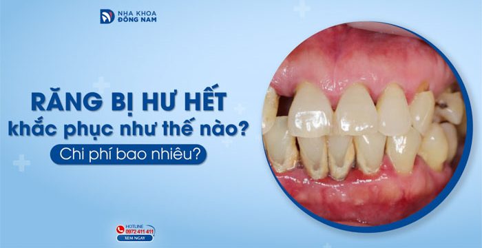Răng bị hư hết khắc phục như thế nào? Chi phí bao nhiêu?