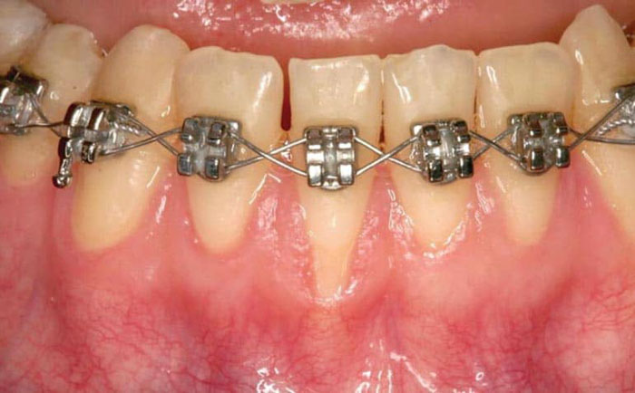 Răng dài ra và cảm giác ê buốt là dấu hiệu cho thấy răng bị tụt lợi