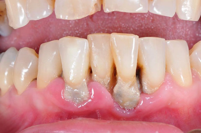 Răng khấp khểnh làm tăng nguy cơ mắc bệnh viêm nướu viêm nha chu